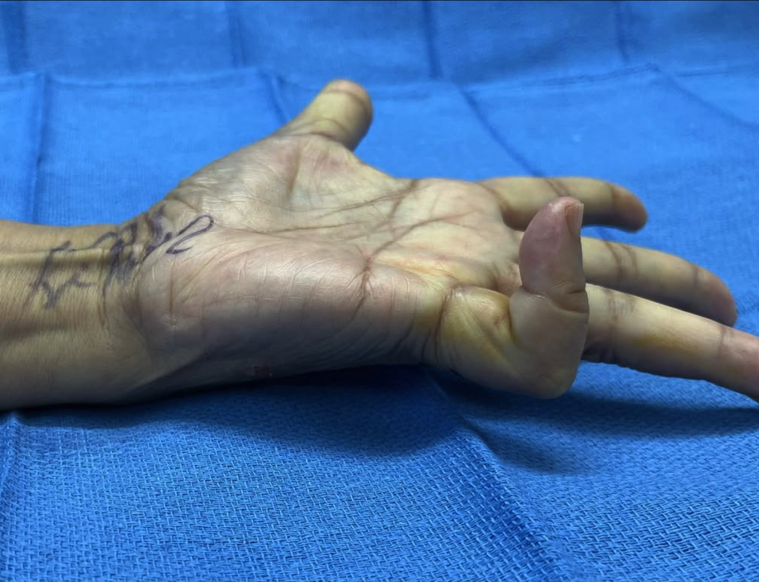 Several years of Dupuytren’s contracture of the small finger and loss of function is quickly and painlessly corrected with a Needle Aponeurotomy Procedure. Photo from Dr. Raskin
